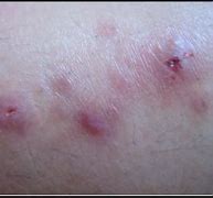 一期梅毒又称硬下疳,发生在阴部不疼不痒的炎症性浅溃疡,指甲大小,肉