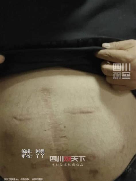 南京胖哥满肚刀伤或做第3次手术|南京市_新浪新闻