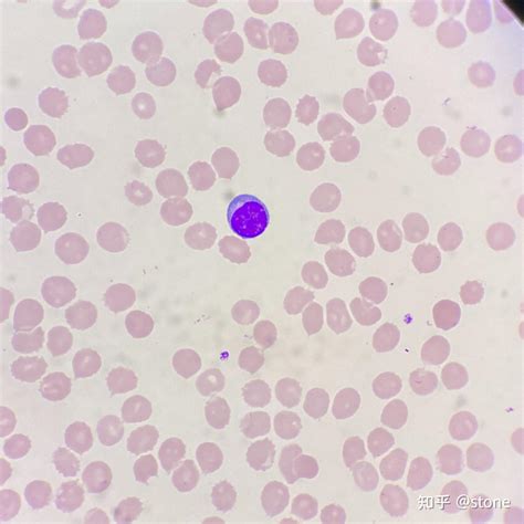 异型淋巴细胞-5 - 知乎