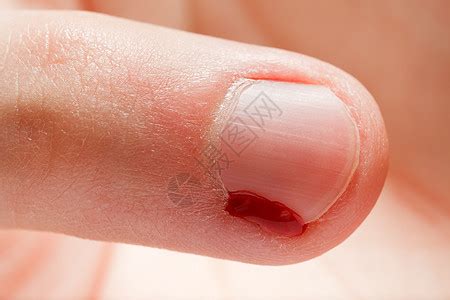 血伤口指甲溃疡疾病手指瘢痕事故伤害癌症身体表皮疼痛高清图片下载-正版图片321089700-摄图网