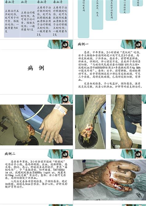 中医外治治疗毒蛇咬伤肿胀的研究,中医外科学论文_学术堂