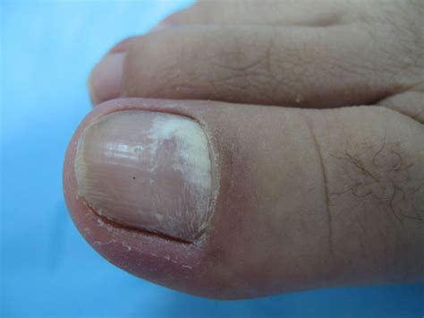 灰指甲早期怎样治疗-灰指甲治疗-复禾健康