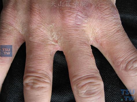 疥疮（scabies）的症状表现 - 皮肤病学 - 天山医学院