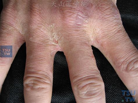 【附图】 疥疮（scabies）的症状表现 _皮肤病诊断图谱 | 天山医学院