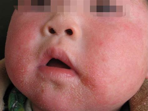 得了婴儿湿疹的危害有什么_婴儿湿疹_北京京城皮肤医院(北京医保定点机构)