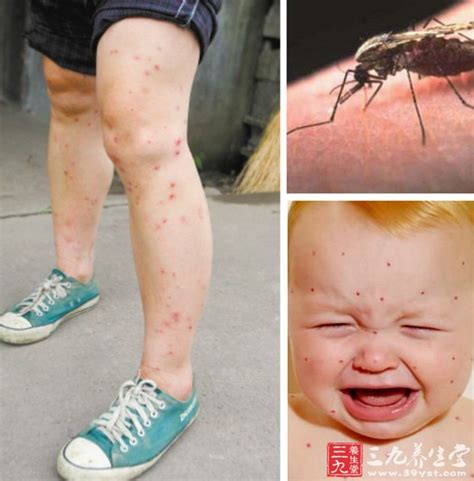 皮肤蚊虫叮咬过敏症状,蚊虫叮咬皮肤(第2页)_大山谷图库