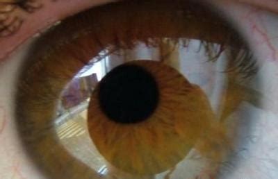 历史上的重瞳子是真实存在的吗？两个瞳仁在眼睛里是如何分布的？ - 知乎