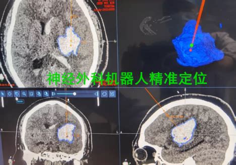 【行业资讯】高血压引发脑出血 神经外科机器人定位30分钟内 ...