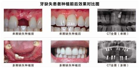种植一颗牙齿价格是多少?北京、上海种植牙收费价格表更新 - 爱美容研社