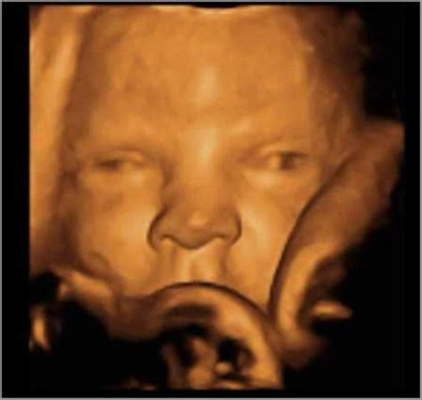 胎儿先天畸形图片_胎儿先天畸形症状表现图片大全_有来医生