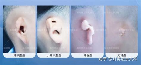 小耳孩子家长需留意，小耳畸形3种类型对照图 - 知乎
