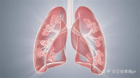 日本国立大学研发槲皮素肺部枇杷叶罗汉果复合片30年烟肺-淘宝网