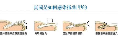 灰指甲百科-重庆迪邦医院_重庆皮肤病/皮肤科哪家医院比较好_重庆最好的皮肤医院