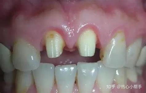 活动假牙、固定义齿、种植牙三种常用的牙齿修复方式优缺点对比 - 知乎