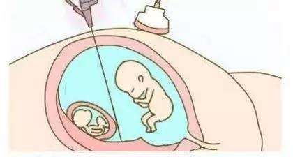 泰国试管婴儿生双胞胎也不是想生就生，必要的时候还需要减胎__凤凰网