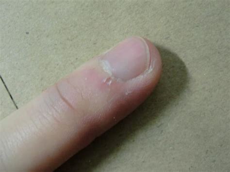 大拇指手指甲凹凸不平 到底是什么原因引起