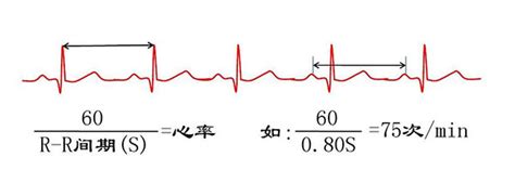 心电轴的测量方法，你掌握了几种？_振幅