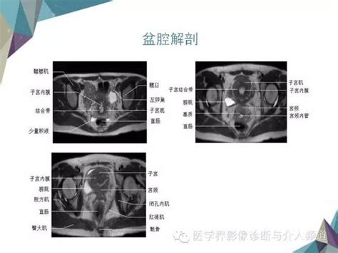 宫颈癌的影像学分期