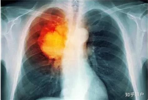肺癌手术多少钱 肺癌的手术费用多少_有来医生