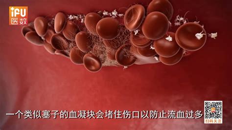 静脉血栓图片