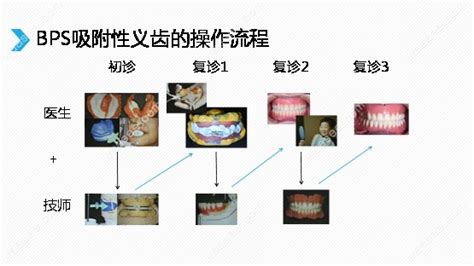 (种植覆盖义齿)半固定种植牙和活动假牙的区别有以下5点 - 口腔资讯 - 牙齿矫正网