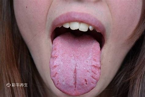 舌头有裂纹是怎么回事 舌头有裂纹是什么原因导致的_三思经验网