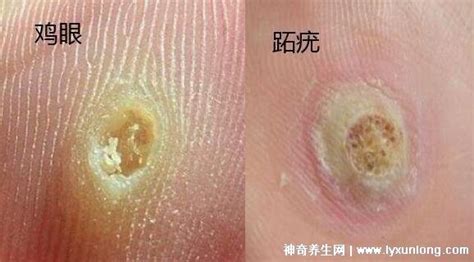 病毒疣图片