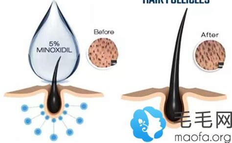 脱发难题已攻克？干细胞外泌体促进毛囊再生，解决脱发难题！_研究_毛发_治疗