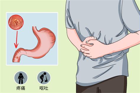 胃十二指肠溃疡的临床表现有哪些-京东健康