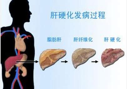 肝硬化的肝脏图片