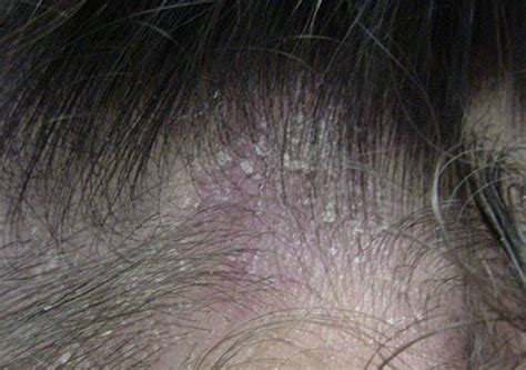 脂溢性脱发怎么治疗最有效（脂溢性皮炎为什么会导致脱发？脂溢性皮炎该怎么办？） | 说明书网
