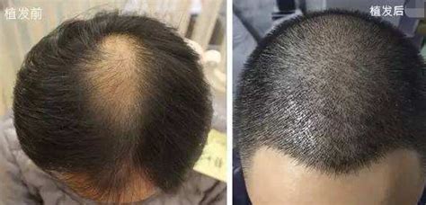 更新一则种植毛发案例:分享额前毛发种植恢复过程图_郑州碧莲盛植发植发案例 - 毛毛网