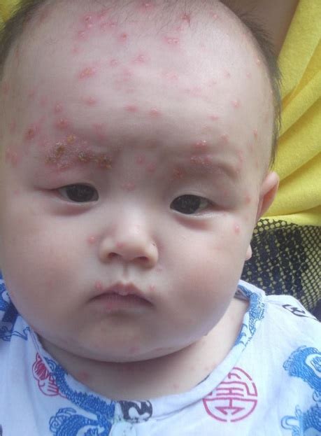 宝宝水痘的症状和图片,宝宝水痘症状,四个月宝宝起水痘图片_大山谷图库