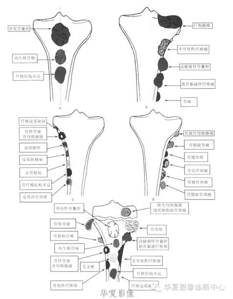 骨肿瘤图片