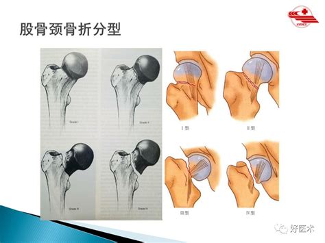 股骨颈骨折图片