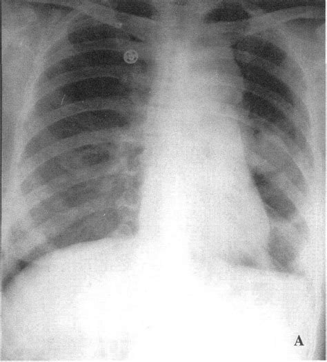 呼吸病理学：肺癌其一-概述+肺鳞癌+肺腺癌 - 知乎