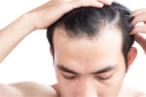 严重脱发是什么原因，怎么治疗严重脱发 – 生发垂直网