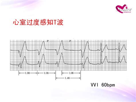 15-18 右室心尖部起搏心律，V1 ～V6呈QS型-心血管-医学