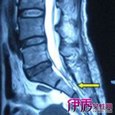 脊柱裂图片