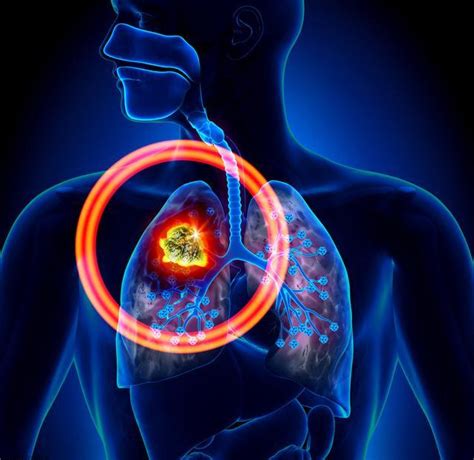 吡咯替尼用于HER2并晚期非小细胞肺癌患者的疗效分析_医学界-助力医生临床决策和职业成长