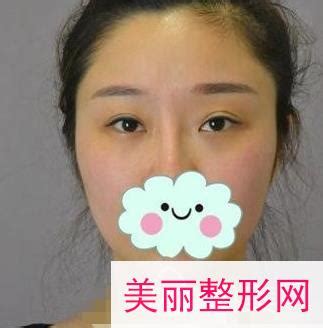 上海九院李青峰做鼻子怎么样？附手术案例及术后对比图-欣美整形网