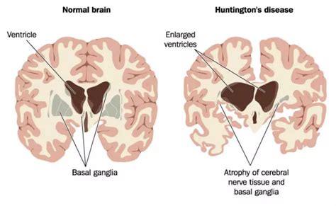 脑淀粉样血管病（CAA）最新诊断标准 Boston2.0 - 脑医汇 - 神外资讯 - 神介资讯
