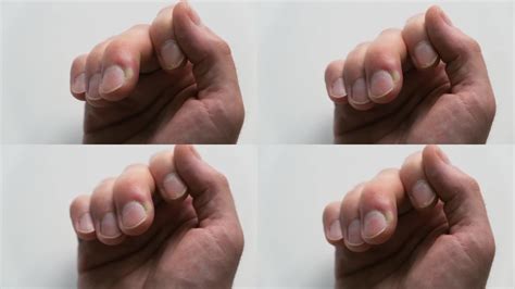 白色背景上的手指肿胀。由于急性甲沟炎，手指的远端指骨表现出肿胀。角质层的感染_3840X2160_高清视频素材下载(编号:19489600 ...