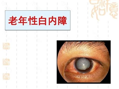 贵阳爱尔：一次手术解决白内障、老花两大问题，让患者重获高清“视”界 - 中国网客户端