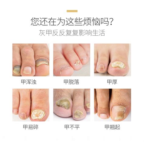 灰指甲专用液脱甲膏正品非治療冰醋酸去软甲膏脚趾抑菌液藥灰甲净