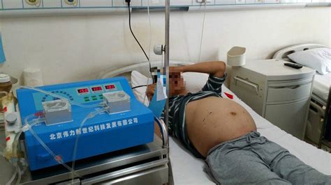 轻度肚子腹水图片