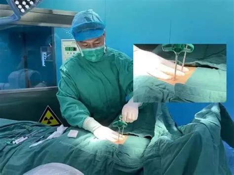 县医院也可做高难度骨科手术 广州医生填补饶平县多项技术空白