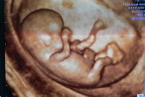 胎儿颜面部畸形超声诊断思路：胎儿小下颌异常