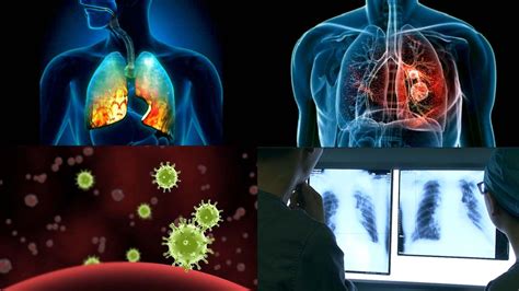 肺炎图片