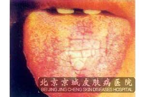口腔白斑病图片